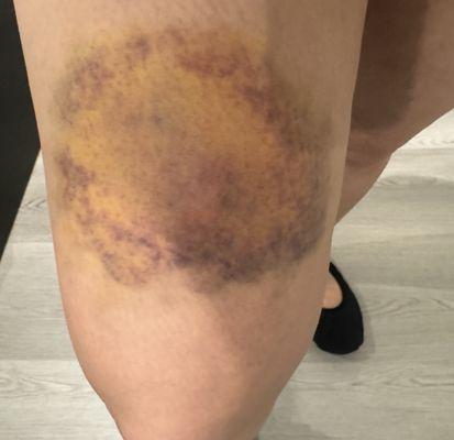 Bruise