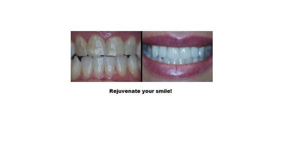 Rejuvenate your smile!