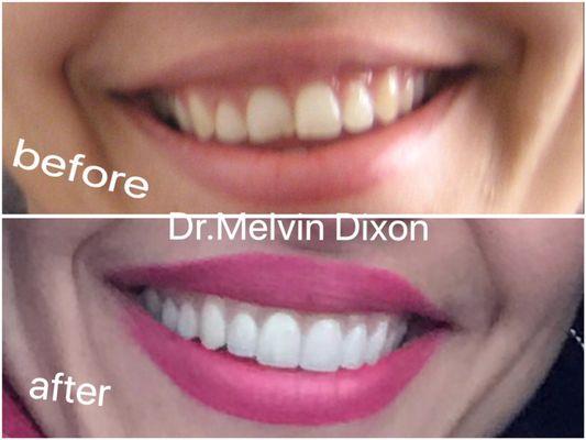 work of Dr Dixon. I am so happy with my smile that I just want to share with the world! lol