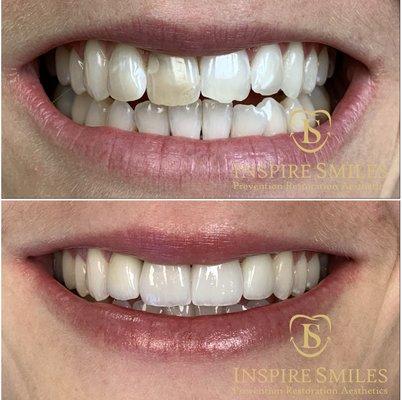 Beautiful and natural smile enhancement w porcelain veneers.