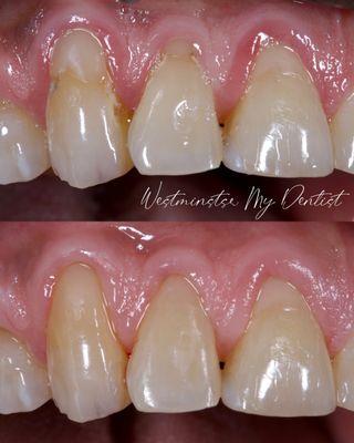 Gum Disease treatment and replacement of two Direct Composite Bonding Restoration shows evident improvements of texture, color, and shape.