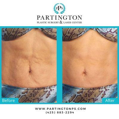 SkinTyte: A Non-Surgical Skin Tightening