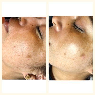 Beautiful glow after one treatment using dermalogica pro peels