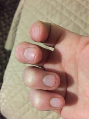 Nails cut down way too short. They are very painful.