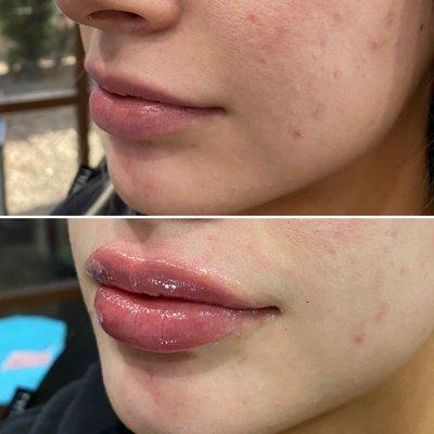 Lip filler by Ali