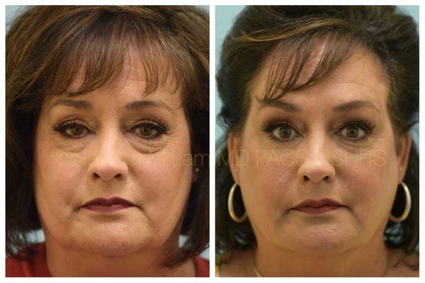 This 57-year-old patient of Dr. Lam is shown before and one year after a fat transfer to the upper and lower eyelids.