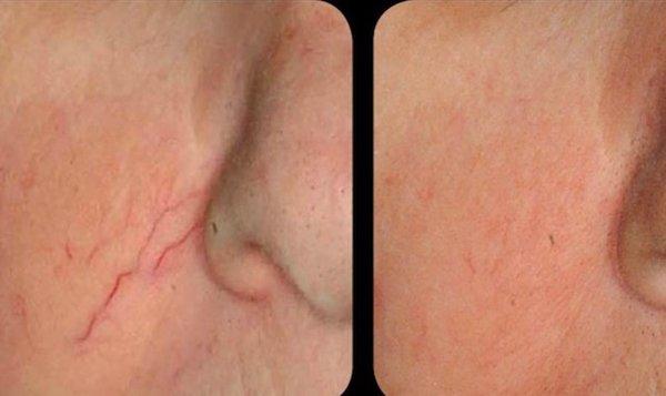 Before and after VBeam laser for broken capillaries.