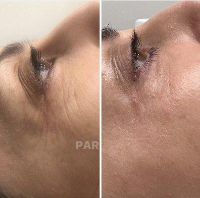 PLASMA SKIN TIGHTENING 1 SESSION