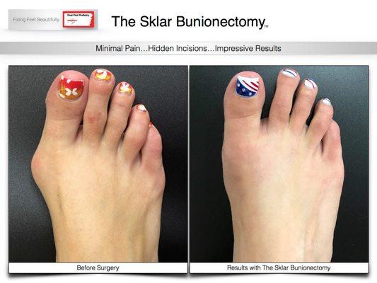 Take the first step towards solving your foot problem with the Sklar Bunionectomy. Visit www.footfirst.com for more information.