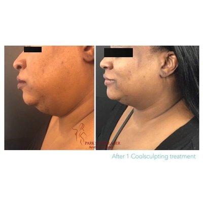 Coolsculpting progress photo (not final result) on chin area. (718) 369-0019 free consultations