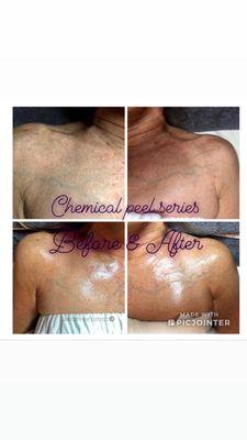 Chemical peel series before and after