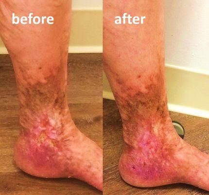 Dr. Malvehy specializes in revision for patient who have failed varicose vein treatment elsewhere, including for venous ulcers.