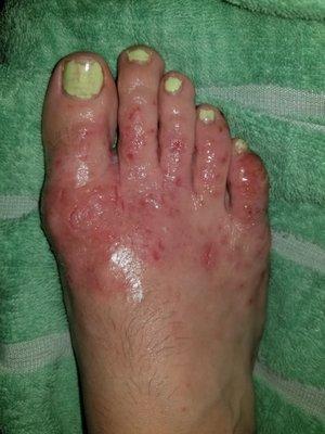 Went to get a pedicure... came out with staph infection and strep on my foot... it stared small and this is what it looks like now...