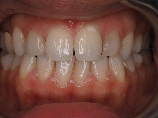 patient unhappy with space between front teeth and too large lateral incisors