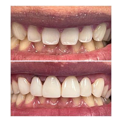 Bioclear bonding to change shape of teeth