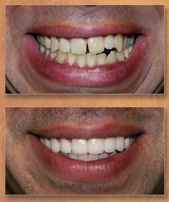 Veneers