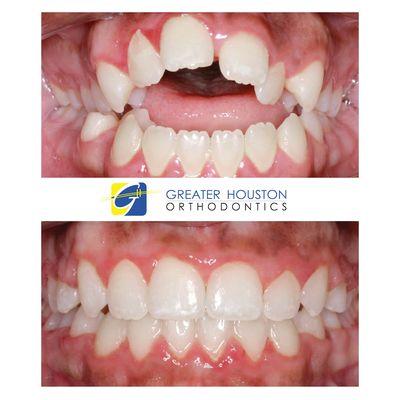 Open bite correction by Greater Houston Orthodontics board certified orthodontists.