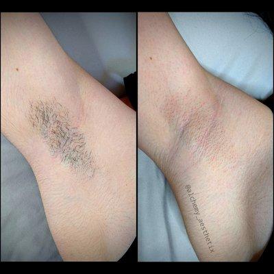 Before//After - Women's Underarm Wax Service