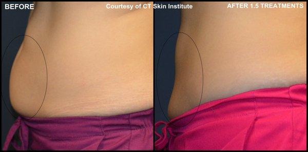 CoolSculpting Before & After  *Results may vary depending on the individual.