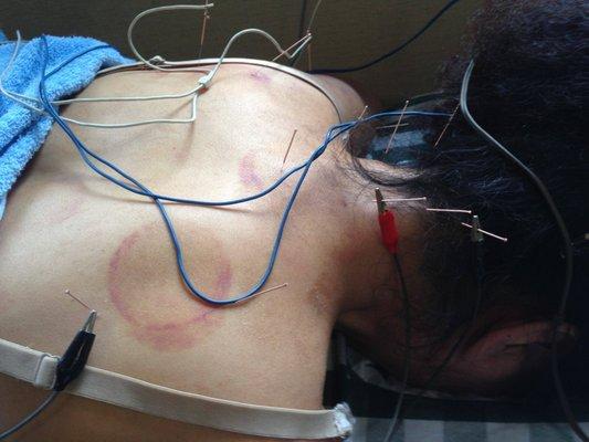 Electrostim for Pain and Sports Injury