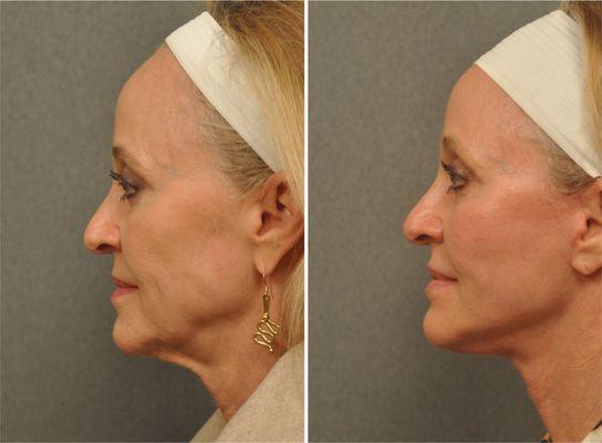 Changes Rapid Lift, face and neck lift performed under local anesthetic. Affordable and effective.