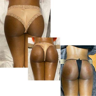 This client completed two sessions of butt enhancements with contouring of the waist line.