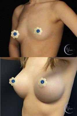 Breast Augmentation