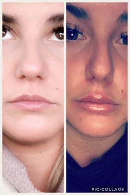 Lips by Nina! Photo taken directly after injections, so still swollen. But she did a wonderful job. Would definitely recommend