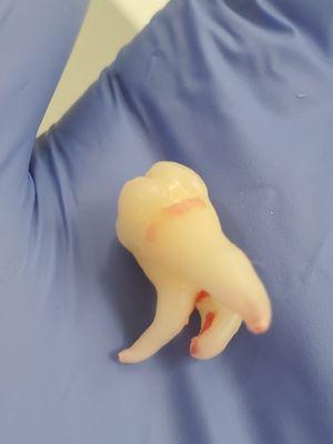 One of the hardest wisdom tooth extractions but we got it done for the patient without the need to go under sedation!