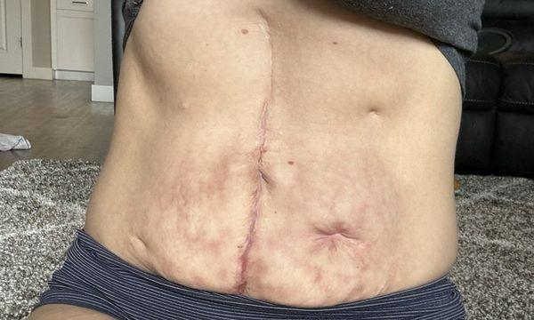 Physical evidence of the trauma my abdomen has been through to warrant being treated with respect and taken seriously.