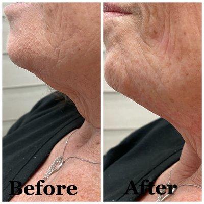 Neck lift with PDO threads