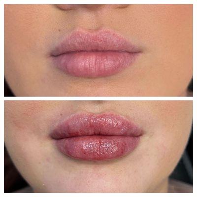 Lips / juvederm lip filler