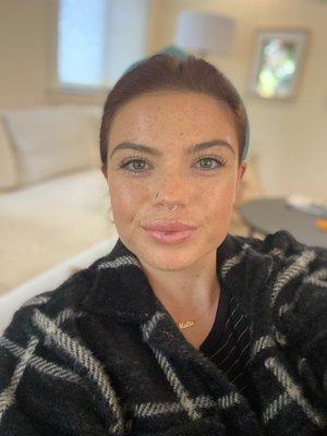 So happy with my Botox and Lip Filler by Dr.Conderman