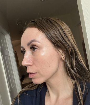 My skin after my treatment with Hanna. I am 38 years old