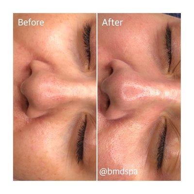 Before & After | Hydrafacial | zoom in to see the difference! You will be surprised by how your skin is glowing right after the treatments!