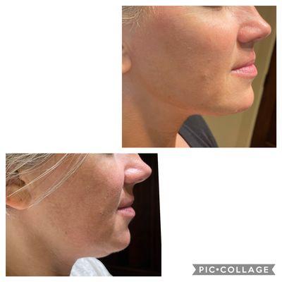 Morpheus8 jawline definition and double chin correction!