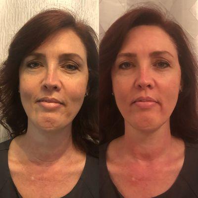 1 session of Thermalift(RF) & Ultralift addressed fine lines & wrinkles, while lifting the face and neck. Ultralift was focused under eyes.