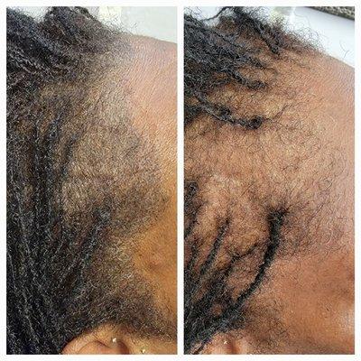 Scalp Micropigmentation done as a density client on a female.