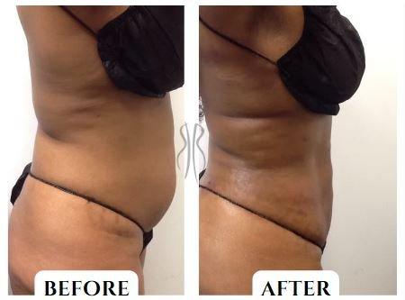 Before & After: Lipo of upper and lower abdomen