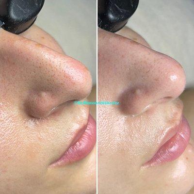 Before/After Hydrafacial MD