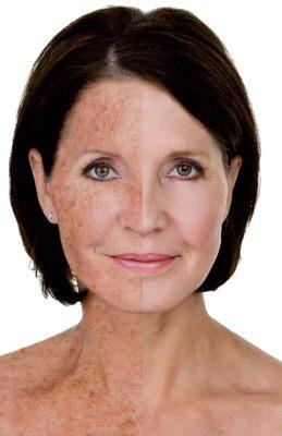 TCA and more advanced Chemical Peels starting at $75 352-325-0296