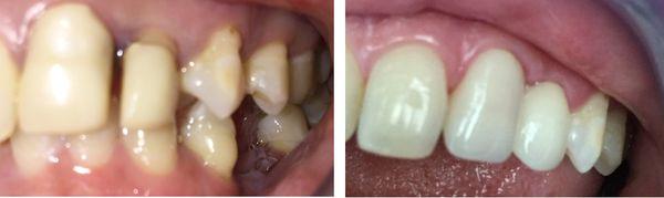 Before / Afters - Dentist in Daly City, CA 94014