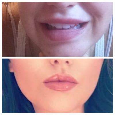 Top picture - Dr. Loverme mutilated my lips - uneven, slanted sideways, dented in Bottom picture - After a DIFFERENT Doctor fixed my lips