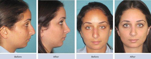 Rhinoplasty Before & After