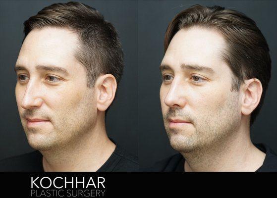 Before and After Rhinoplasty