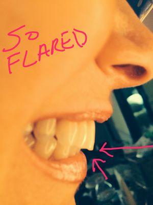 EDF ASSISTANT MADE FLARED TEMPORARY TEETH, DR. SHOULD HAVE NOTICED THEY WERE FLARED, I SENT HIM THIS PHOTO.