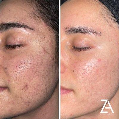 Microneedling and Chemical Peel