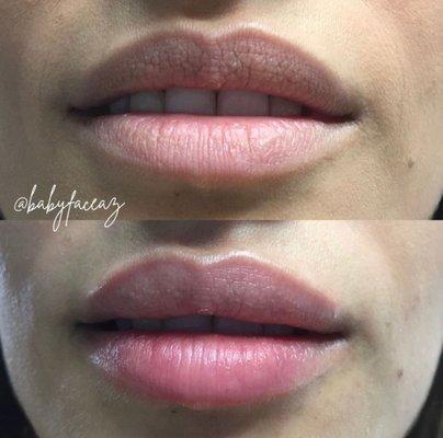 Lip filler Scottsdale AZ at BabyFace Med Spa