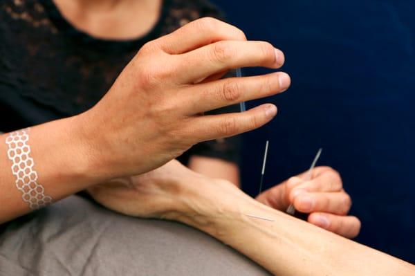 Berkeley Community Acupuncture