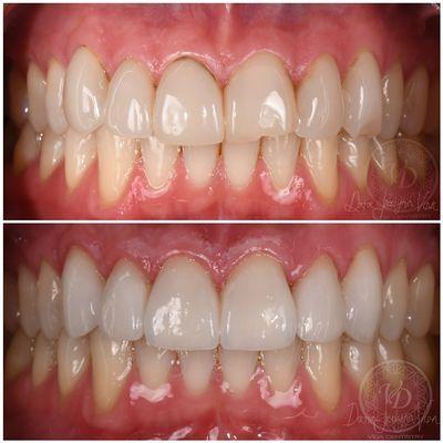 Replacement of 6 old porcelain veneers from a patient from San Diego